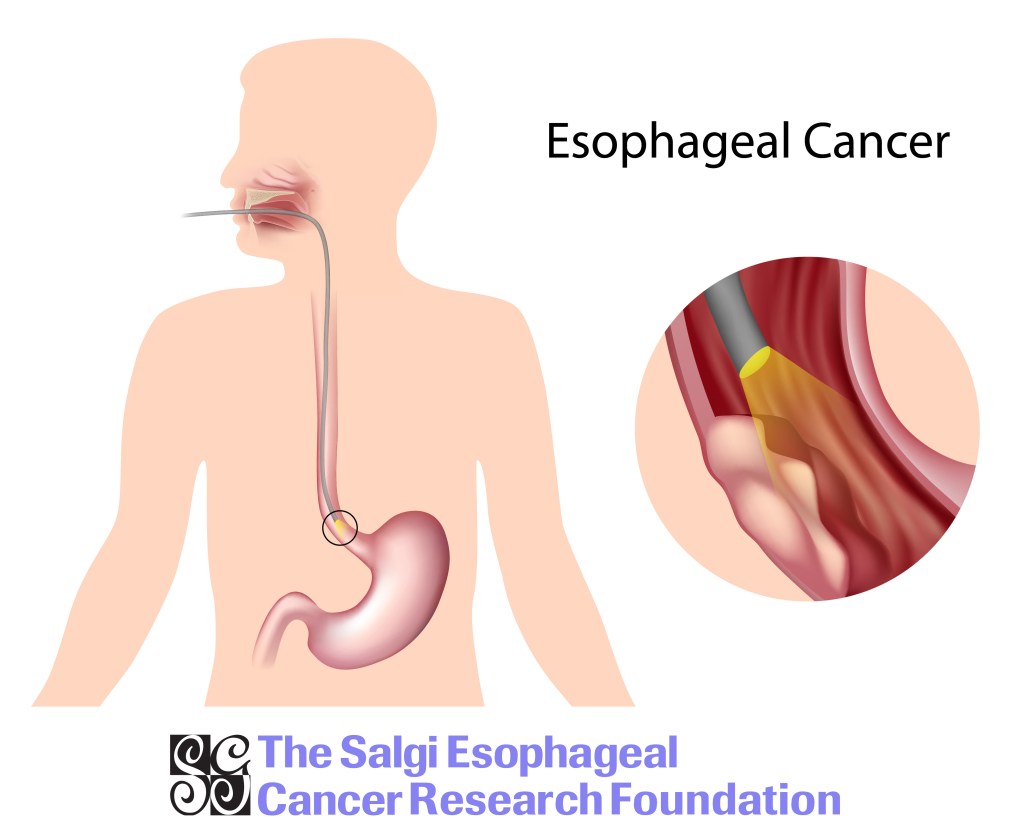 esophageal cancer, esophageal cancer ri, esophagus cancer, cancer of the esophagus, cancer ri, ri cancer, ri esophageal cancer, cancer treatment, cancer ri treatment, esophageal cancer treatment, esophageal cancer treatment ri, rhode island cancer, cancer rhode island, nonprofit, non profit ri, ri nonprofit, ri non-profit, esophageal non profit, esophagus, barret esophagus, barret esophagus ri, esophagus ri, ri esophagus, esophageal cancer rhode island, gerd, GERD ri, ri gerd, GERD treatment, GERD, GERD help, heartburn, heartburn ri, heartburn treatment, treatment heartburn, acid reflux, acid reflux ri, acid reflux treatment, acid reflux help, ri acid reflux, esophageal cancer, esophageal cancer ri, ri cancer, cancer ri, cancer rhode island, esophageal cancer rhode island, rhode island esophageal cancer, heartburn, acid reflux, gerd, reflux, gerd reflux, acid, pain in chest, doctor ri, gi doctor ri, gastroenterologist ri, ri gastroenterologist, ri health, health ri, esophageal cancer awareness, esophageal cancer treatment, esophageal cancer diagnosis, esophageal cancer research, esophageal cancer donate, esophageal cancer funding, esophageal cancer fund, esophageal cancer funds, esophageal cancer , esophageal cancer awareness, esophageal cancer nonprofit, esophageal cancer events, esophageal cancer rhode island, esophageal cancer new england, esophageal cancer Massachusetts, esophageal cancer screening, esophageal cancer detection, esophageal cancer signs, esophageal cancer symptoms, esophageal cancer diagnosis, esophageal cancer doctors, esophageal cancer doctors in ri, esophageal cancer doctor ri, esophageal cancer symptom, esophageal cancer heartburn, heartburn can cause cancer, cancer heartburn, heartburn cancer, esophageal cancer salgi, esophageal cancer rates, esophageal cancer death, esophageal cancer death rate, esophageal cancer survivors, esophageal cancer survivor, esophageal cancer survivorship, esophageal cancer surviving, esophageal cancer groups, esophageal cancer organizations, esophageal cancer teams, esophageal cancer board, esophageal cancer charity, esophageal cancer nonprofit, esophageal cancer money for research, Networking RI, cancer ri, esophageal cancer, cancer in ri, networking event ri, cancer charity, cancer research, cancer charity ri, cancer research ri, esophageal cancer awareness, esophageal cancer awareness ri, esophageal cancer research ri, esophageal cancer research, esophageal cancer prevention, esophageal cancer prevention ri, esophageal cancer cure, esophageal cancer, in hopes of a cure, networking cancer, cocktails in hopes of a cure, cocktails, Esophageal Cancer Walk/Run, Cancer Walk, Cancer Walk RI, Walk RI, Run RI, Rhode Island Walk, Rhode Island Cancer, Cancer Walks in RI, Cancer Run in RI, Run for charity, Run in RI, cancer run, cancer walk, cancer walk ri, cancer run ri, esophageal cancer, cancer of the esophagus, cancer, esophageal cancer ri, cancer of esophagus, ri cancer, cancer awareness, cancer research, cancer prevention, ri cancer research, ri cancer prevention, ri cancer treatment, ri cancer charity, charity ri, charity, cancer, treat esophageal cancer, treat cancer, treatment of esophageal cancer, treatment of esophageal cancer ri, acid reflux, heartburn can cause cancer, heartburn ri, acid reflux ri, heartburn, heartburn remedy, heartburn remedies, acid reflux remedies, charity run ri, charity walk ri, run for cancer esophageal cancer, esophageal cancer ri, ri cancer, cancer ri, cancer rhode island, esophageal cancer rhode island, rhode island esophageal cancer, heartburn, acid reflux, gerd, reflux, gerd reflux, acid, pain in chest, doctor ri, gi doctor ri, gastroenterologist ri, ri gastroenterologist, ri health, health ri, esophageal cancer awareness, esophageal cancer treatment, esophageal cancer diagnosis, esophageal cancer research, esophageal cancer donate, esophageal cancer funding, esophageal cancer fund, esophageal cancer funds, esophageal cancer , esophageal cancer awareness, esophageal cancer nonprofit, esophageal cancer events, esophageal cancer rhode island, esophageal cancer new england, esophageal cancer Massachusetts, esophageal cancer screening, esophageal cancer detection, esophageal cancer signs, esophageal cancer symptoms, esophageal cancer diagnosis, esophageal cancer doctors, esophageal cancer doctors in ri, esophageal cancer doctor ri, esophageal cancer symptom, esophageal cancer heartburn, heartburn can cause cancer, cancer heartburn, heartburn cancer, esophageal cancer salgi, esophageal cancer rates, esophageal cancer death, esophageal cancer death rate, esophageal cancer survivors, esophageal cancer survivor, esophageal cancer survivorship, esophageal cancer surviving, esophageal cancer groups, esophageal cancer organizations, esophageal cancer teams, esophageal cancer board, esophageal cancer charity, esophageal cancer nonprofit, esophageal cancer money for research, the salgi foundation, the salgi esophageal cancer research foundation, salgi, salgi foundation, salgi esophageal, salgi esophageal cancer, salgi esophageal cancer research, salgi esophageal cancer research foundation, salgi esophageal foundation, foundation salgi, esophageal cancer awareness salgi, esophageal cancer awareness salgi ri, ri esophageal cancer awareness salgi, ri salgi esophageal cancer, salgi esophageal cancer awareness ri salgi, salgi treatment esophageal cancer, salgi treatment esophageal cancer awareness, salgi treatment esophageal cancer awareness ri, Esophageal Cancer Walk/Run, Cancer Walk, Cancer Walk RI, Walk RI, Run RI, Rhode Island Walk, Rhode Island Cancer, Cancer Walks in RI, Cancer Run in RI, Run for charity, Run in RI, cancer run, cancer walk, cancer walk ri, cancer run ri, esophageal cancer, cancer of the esophagus, cancer, esophageal cancer ri, cancer of esophagus, ri cancer, cancer awareness, cancer research, cancer prevention, ri cancer research, ri cancer prevention, ri cancer treatment, ri cancer charity, charity ri, charity, cancer, treat esophageal cancer, treat cancer, treatment of esophageal cancer, treatment of esophageal cancer ri, acid reflux, heartburn can cause cancer, heartburn ri, acid reflux ri, heartburn, heartburn remedy, heartburn remedies, acid reflux remedies, charity run ri, charity walk ri, run for cancer